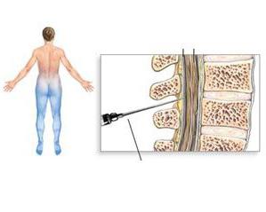 l'anestesia epidurale è