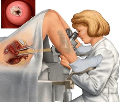 una biopsia della cervice che è 