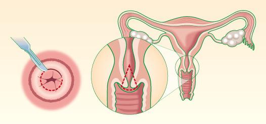 dove fare una biopsia cervicale