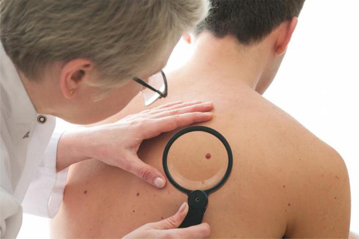 Dermatoscopia di neoplasie