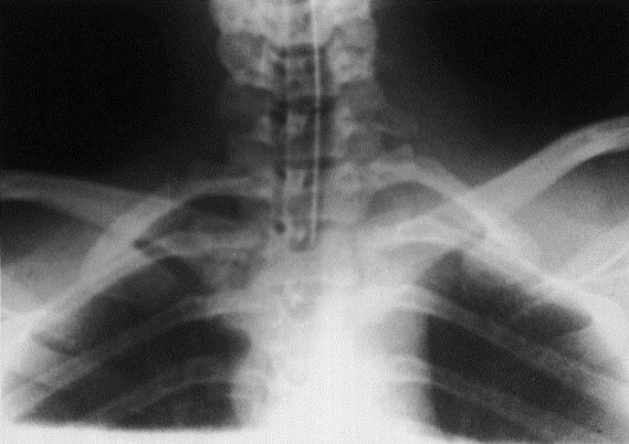 Articolazione seno-clavicolare: struttura