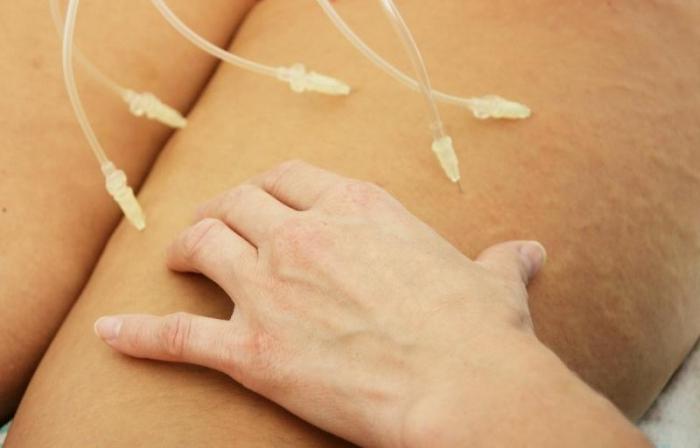 L'ozonoterapia in cosmetologia è un'alternativa alle procedure chirurgiche