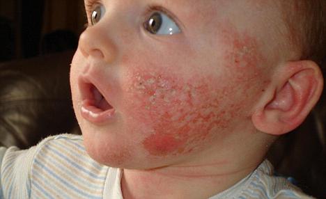 Perché le eruzioni cutanee appaiono sul viso di un bambino?