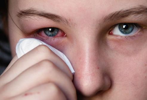 Rossore del bulbo oculare: cause e trattamento