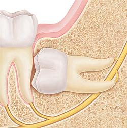 conseguenze della saggezza dell'estrazione del dente