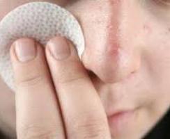 Le cause di acne sul viso e come sbarazzarsi di loro