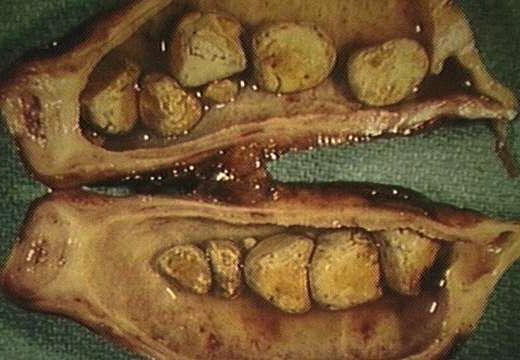 I sintomi della colecistite cronica e la sua diagnosi