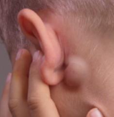 perché i linfonodi infiammati dietro le orecchie
