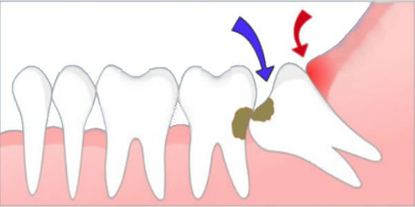 perché hai bisogno di denti del giudizio