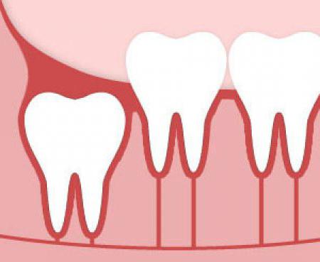 perché hai bisogno di denti del giudizio, infatti